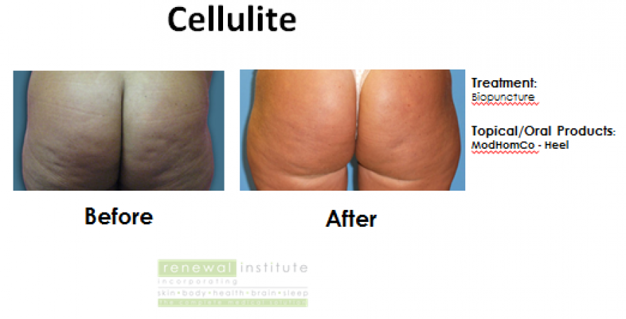 Cellulite Ba Biopuncture Slider Image