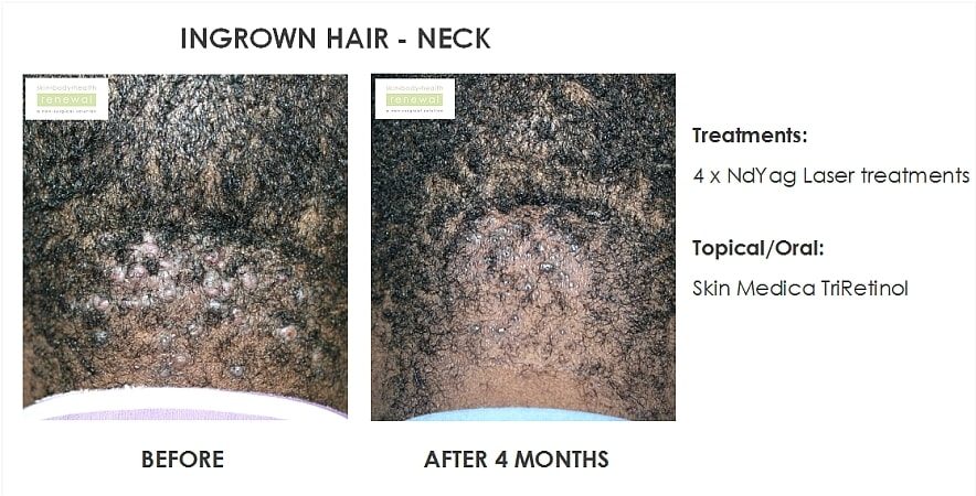 Ingrown Har In Neckl 4 X Ndyag Laser Treatments Product Skin Medicatriretinol 4 Months Before And After Slider Image