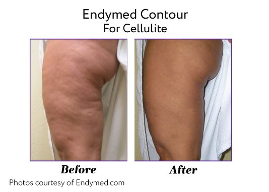 Endymed Before And After Endymed Contour Body Treatments Cellulite