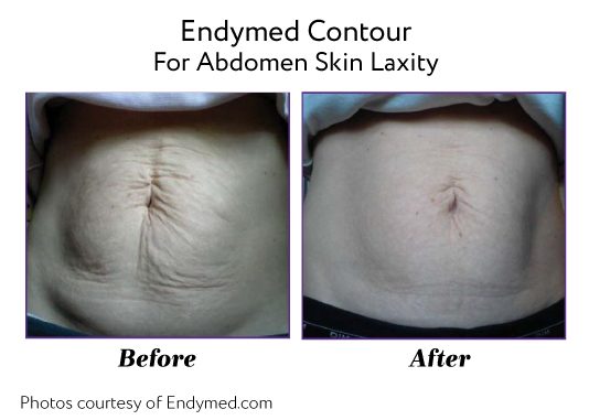 Endymed Before And After Endymed Contour Body Treatments For Skin Laxity Stomach