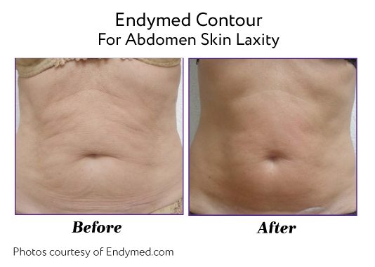 Endymed Before And After Endymed Contour Body Treatments For Skin Laxity