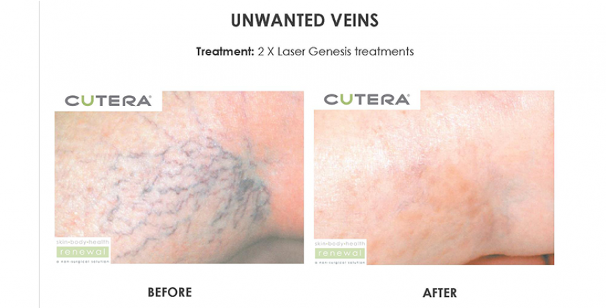 Unwanted Vein Removal 2 X Laser Genesis Treatments Before After Cutera Skin Body Health Renewal Slider Image