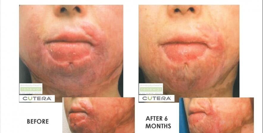 Burn Scars Face 7 Laser Genesis Treatments At 3 Week Intervals For 6 Months Before After Cutera Skin Body Health Renewal Slider Image