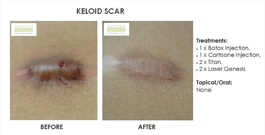 Keloid Scarring Botox Cortisone Titan X2 Laser Genesis X2 Slider Image