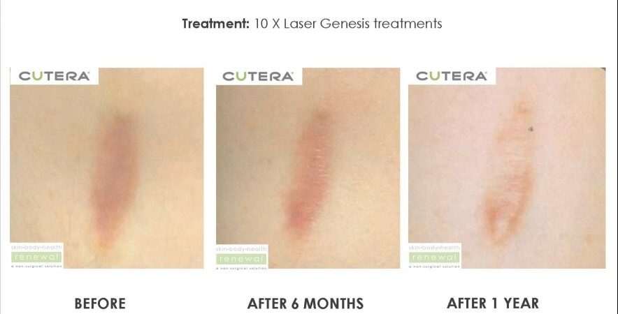 Atrophic Surgical Scar 10 X Laser Genesis Treatment Before After 1 Year Cutera Skin Body Health Renewal Slider Image