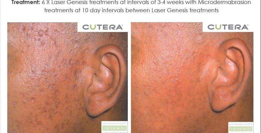 Chicken Pox Scars 6 X Laser Genesis Treatments And Microdermabrasion Before After 3 Months Cutera Skin Body Health Renewal Slider Image