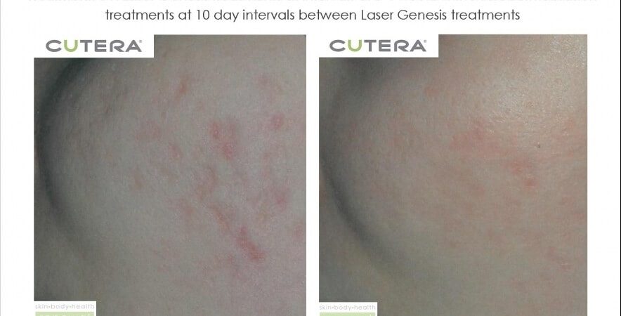 Chicken Pox Scars 3 X Laser Genesis Treatments And Microdermabrasion Before After 6 Months Cutera Skin Body Health Renewal Slider Image