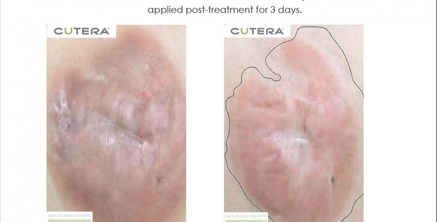 Keloid Scarring 2 3 Week Interval Treatment For 10 Months Topical Steroid Ointment Before After 10 Months Cutera Skin Body Health Renewal Slider Image