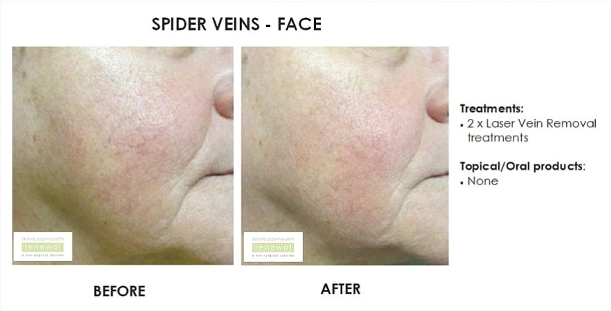 Spider Veins Face 2 X Laser Vein Removal Treatments No Products Before And After 1 Slider Image
