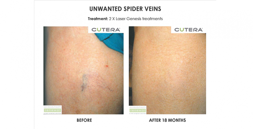 Unwanted Spider Vein Removal 2 X Laser Genesis Treatments Before After 18 Months Cutera Skin Body Health Renewal Slider Image